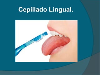 Cepillado Lingual.
 