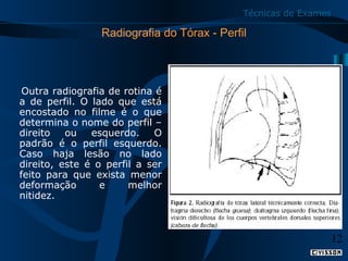 Técnicas de Exames

Radiografia do Tórax - Perfil

    Outra radiografia de rotina é 
a  de  perfil.  O  lado  que  está 
encostado  no  filme  é  o  que 
determina o nome do perfil – 
direito  ou  esquerdo.  O 
padrão  é  o  perfil  esquerdo. 
Caso  haja  lesão  no  lado 
direito,  este  é  o  perfil  a  ser 
feito  para  que  exista  menor 
deformação 
e 
melhor 
nitidez.

12

 