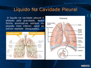 Técnicas de Exames

Líquido Na Cavidade Pleural
O líquido na cavidade pleural é
afetado pela gravidade, desta
forma acumula-se sempre na
posição mais inferior, salvo se
estiver septado (bloqueado).

23

 