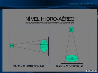Técnicas de Exames

NÍVEL HIDRO-AÉREO
EM QUALQUER CAVI DADE QUE CONTENHA LÍ QUI DO E GÁS

AR

LÍQUIDO

AR
LÍQUIDO

RAI O - X HORI ZONTAL

RAIO - X VERTICAL

25

 