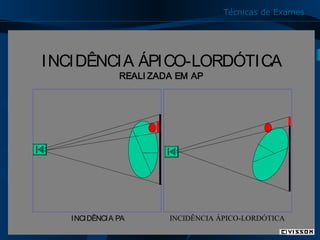 Técnicas de Exames

INCIDÊNCIA ÁPICO-LORDÓTICA
REALI ZADA EM AP

INCIDÊNCIA PA

INCIDÊNCIA ÁPICO-LORDÓTICA

29

 
