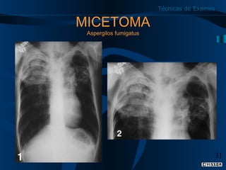 Técnicas de Exames

MICETOMA
Aspergilos fumigatus

31

 