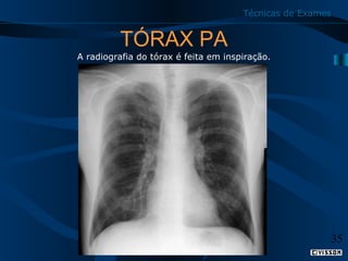 Técnicas de Exames

TÓRAX PA

A radiografia do tórax é feita em inspiração.

35

 