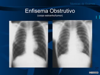 Técnicas de Exames

Enfisema Obstrutivo
(corpo estranho/tumor)

37

 