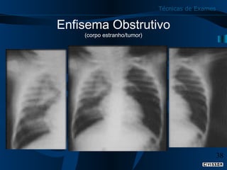 Técnicas de Exames

Enfisema Obstrutivo
(corpo estranho/tumor)

38

 
