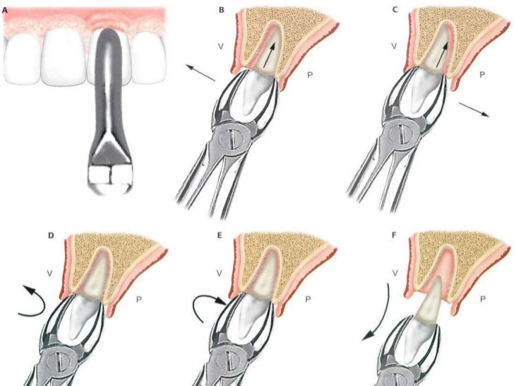 Resultado de imagen para TECNICA PARA EXODONCIA