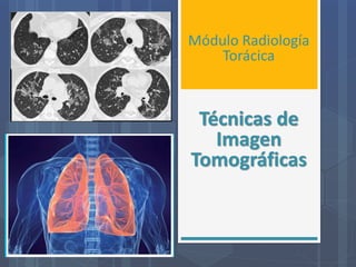 Módulo Radiología
Torácica
Técnicas de
Imagen
Tomográficas
 