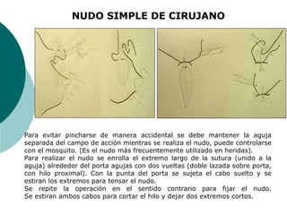Para evitar pincharse de manera accidental se debe mantener la aguja
separada del campo de acción mientras se realiza el nudo, puede controlarse
con el mosquito. (Es el nudo más frecuentemente utilizado en heridas).
Para realizar el nudo se enrolla el extremo largo de la sutura (unido a la
aguja) alrededor del porta agujas con dos vueltas (doble lazada sobre porta,
con hilo proximal). Con la punta del porta se sujeta el cabo suelto y se
estiran los extremos para tensar el nudo.
Se repite la operación en el sentido contrario para fijar el nudo.
Se estiran ambos cabos para cortar el hilo y dejar dos extremos cortos.
NUDO SIMPLE DE CIRUJANO
 