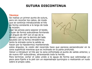 SUTURA DISCONTINUA
Técnica:
Se realiza un primer punto de sutura,
pero sin recortar los cabos, de modo
que se continúa introduciendo el hilo
de forma constante a lo largo de toda
la incisión.
Usar las pinzas para separar el tejido.
Cruzar de forma subcutánea formando
un ángulo de 45º con el eje de la
herida y salir por la dermis del lado
opuesto (en la forma intradérmica,
tanto la entrada como la salida se
hacen por la hipodermis) manteniendo
estos ángulos; la visión del recorrido hace que parezca perpendicular en la
zona superficial mientras que es inclinado en la parte profunda.
Volver a introducir el hilo por la zona enfrentada al punto de salida anterior, y
de nuevo 45º subcutánea, atravesando toda la herida.
Para terminar, cortar el cabo unido a la aguja de forma que sobresalga un
poco para fijarlo a la piel con un esparadrapo quirúrgico o realizando un nudo
sobre el propio cabo.
 