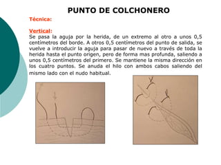 PUNTO DE COLCHONERO
Técnica:
Vertical:
Se pasa la aguja por la herida, de un extremo al otro a unos 0,5
centímetros del borde. A otros 0,5 centímetros del punto de salida, se
vuelve a introducir la aguja para pasar de nuevo a través de toda la
herida hasta el punto origen, pero de forma mas profunda, saliendo a
unos 0,5 centímetros del primero. Se mantiene la misma dirección en
los cuatro puntos. Se anuda el hilo con ambos cabos saliendo del
mismo lado con el nudo habitual.
 