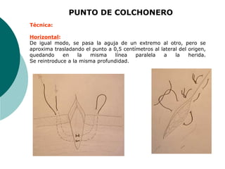 PUNTO DE COLCHONERO
Técnica:
Horizontal:
De igual modo, se pasa la aguja de un extremo al otro, pero se
aproxima trasladando el punto a 0,5 centímetros al lateral del origen,
quedando en la misma línea paralela a la herida.
Se reintroduce a la misma profundidad.
 