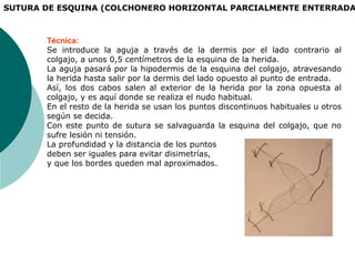 Técnica:
Se introduce la aguja a través de la dermis por el lado contrario al
colgajo, a unos 0,5 centímetros de la esquina de la herida.
La aguja pasará por la hipodermis de la esquina del colgajo, atravesando
la herida hasta salir por la dermis del lado opuesto al punto de entrada.
Así, los dos cabos salen al exterior de la herida por la zona opuesta al
colgajo, y es aquí donde se realiza el nudo habitual.
En el resto de la herida se usan los puntos discontinuos habituales u otros
según se decida.
Con este punto de sutura se salvaguarda la esquina del colgajo, que no
sufre lesión ni tensión.
La profundidad y la distancia de los puntos
deben ser iguales para evitar disimetrías,
y que los bordes queden mal aproximados.
SUTURA DE ESQUINA (COLCHONERO HORIZONTAL PARCIALMENTE ENTERRADA
 