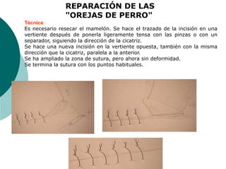 Autor: Alberto Figueroa
Técnica:
Es necesario resecar el mamelón. Se hace el trazado de la incisión en una
vertiente después de ponerla ligeramente tensa con las pinzas o con un
separador, siguiendo la dirección de la cicatriz.
Se hace una nueva incisión en la vertiente opuesta, también con la misma
dirección que la cicatriz, paralela a la anterior.
Se ha ampliado la zona de sutura, pero ahora sin deformidad.
Se termina la sutura con los puntos habituales.
REPARACIÓN DE LAS
"OREJAS DE PERRO"
 