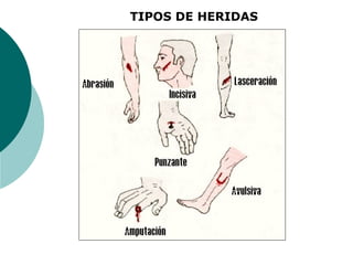 TIPOS DE HERIDAS
 