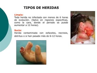 TIPOS DE HERIDAS
Limpia:
Toda herida no infectada con menos de 6 horas
de evolución. (Salvo en regiones especificas,
como la cara, donde el periodo se puede
aumentar a 12 horas).
Sucia:
Herida contaminada con esfacelos, necrosis,
detritus o si han pasado más de 6-12 horas.
 