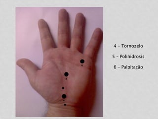 4 – Tornozelo
5 – Polihidrosis
6 – Palpitação
 