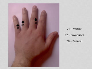 26 – Vértice
27 – Enxaqueca
28 – Perineal
 