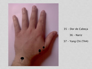 35 – Dor de Cabeça
36 – Nariz
37 – Yang Chi (TA4)
 