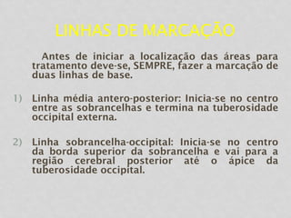LINHAS DE MARCAÇÃO
Antes de iniciar a localização das áreas para
tratamento deve-se, SEMPRE, fazer a marcação de
duas linhas de base.
1) Linha média antero-posterior: Inicia-se no centro
entre as sobrancelhas e termina na tuberosidade
occipital externa.
2) Linha sobrancelha-occipital: Inicia-se no centro
da borda superior da sobrancelha e vai para a
região cerebral posterior até o ápice da
tuberosidade occipital.
 