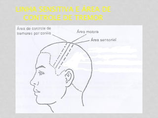 LINHA SENSITIVA E ÁREA DE
CONTROLE DE TREMOR
 