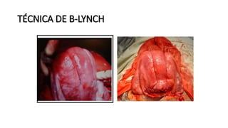 TÉCNICA DE B-LYNCH
 