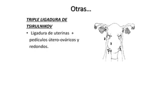 Otras…
TRIPLE LIGADURA DE
TSIRULNIKOV
• Ligadura de uterinas +
pedículos útero-ováricos y
redondos.
 