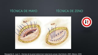 Técnicas quirúrgicas de reparación de pared abdominal.pptx