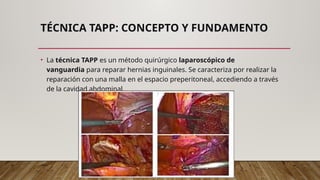 Técnica TAPP (Transabdominal Preperitoneal). Formato residencia pptx | PPTX