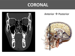 CORONAL
Anterior à Posterior
CORONAL
 