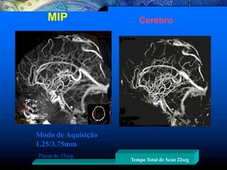 Modo de Aquisição
1.25/3.75mm
Pausa de 15seg
Tempo Total de Scan 22seg
MIP Cerebro
 