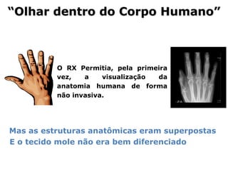 “Olhar dentro do Corpo Humano”
! Mas as estruturas anatômicas eram superpostas
! E o tecido mole não era bem diferenciado
O RX Permitia, pela primeira
vez, a visualização da
anatomia humana de forma
não invasiva.
 