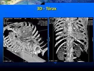 3D - Tórax
 