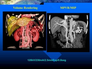 120kV/230mA/2.5mmEsp/0.8seg
Volume Rendering MPVR/MIP
 