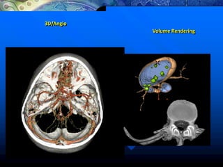 3D/Angio
Volume Rendering
 