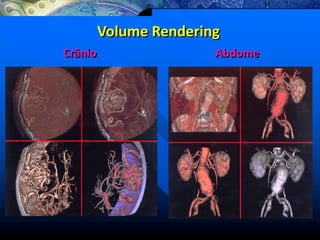 Volume Rendering
Crânio Abdome
 
