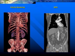 Volume Rendering MPR
 