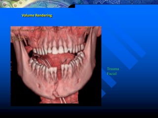Volume Rendering
Trauma
Facial
 