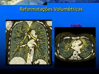 Reformatações Volumétricas
Pulmão
 
