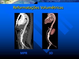 MPR 3D
Reformatações Volumétricas
 