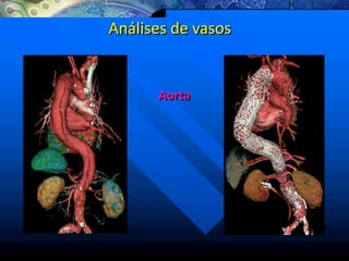 Análises de vasos
Aorta
 