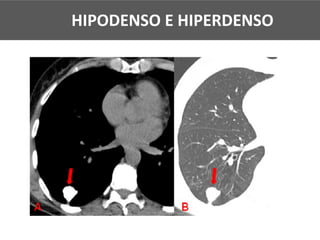 HIPODENSO E HIPERDENSO
 