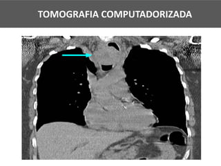 TOMOGRAFIA COMPUTADORIZADA
 