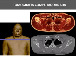 TOMOGRAFIA COMPUTADORIZADA
 