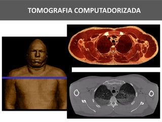 TOMOGRAFIA COMPUTADORIZADA
 