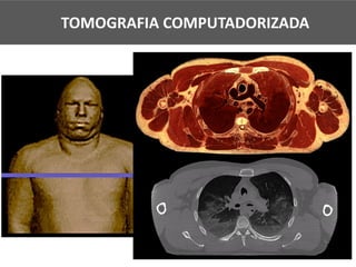 TOMOGRAFIA COMPUTADORIZADA
 