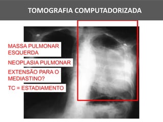 MASSA PULMONAR
ESQUERDA
NEOPLASIA PULMONAR
EXTENSÃO PARA O
MEDIASTINO?
TC = ESTADIAMENTO
TOMOGRAFIA COMPUTADORIZADA
 