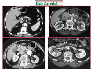 Fase Arterial
 