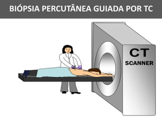 BIÓPSIA PERCUTÂNEA GUIADA POR TC
 
