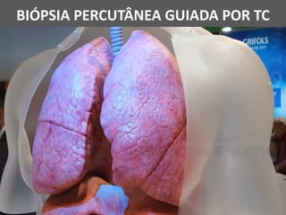BIÓPSIA PERCUTÂNEA GUIADA POR TC
 