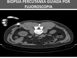 BIÓPSIA PERCUTÂNEA GUIADA POR
FLUOROSCOPIA
 